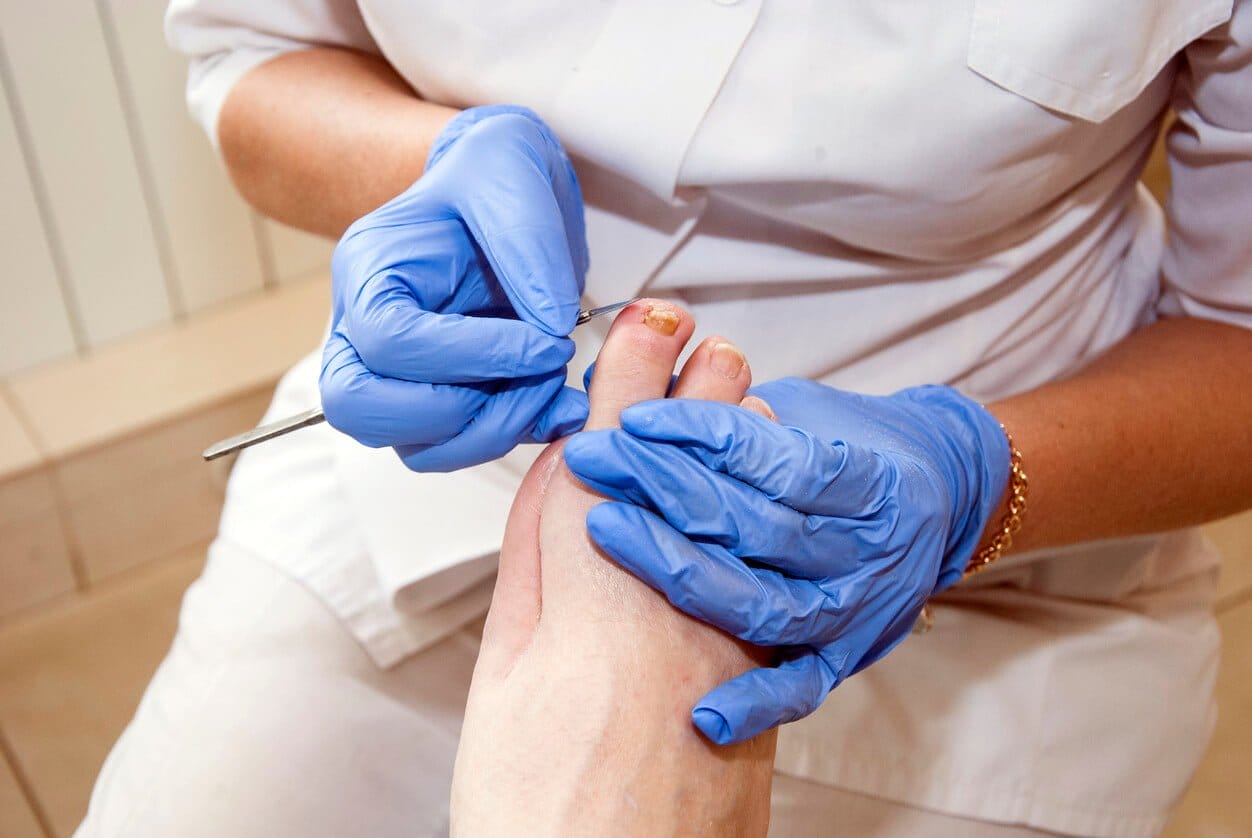 Why Diabetics Should Visit a Podiatrist Regularly