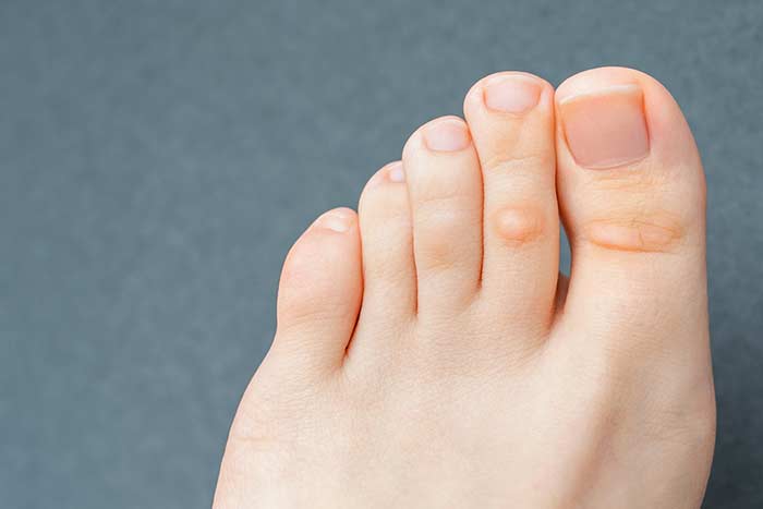 Prevent and Treat Calluses From Running - Fix These Common Feet Problems